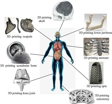 ways to fabricate metallic implants|3D Printing Technologies in Metallic Implants: A Thematic .